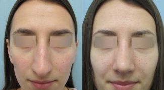 Долгожданная ринопластика