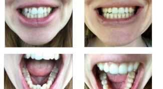 Исправление прикуса капам