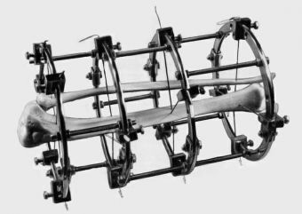 Как снять аппарат Елизарова