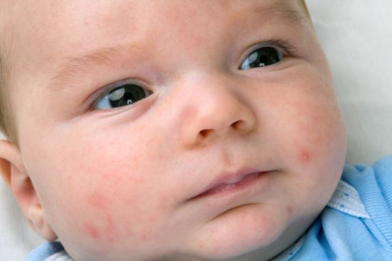 Кожный дерматит у ребенка фото