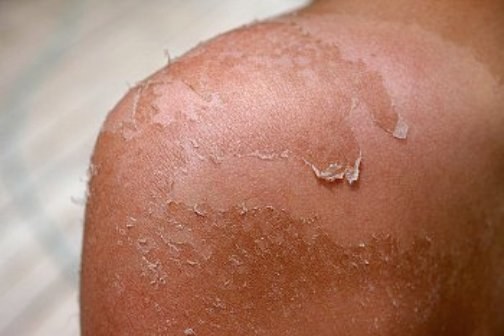 How to treat bubbles with burns