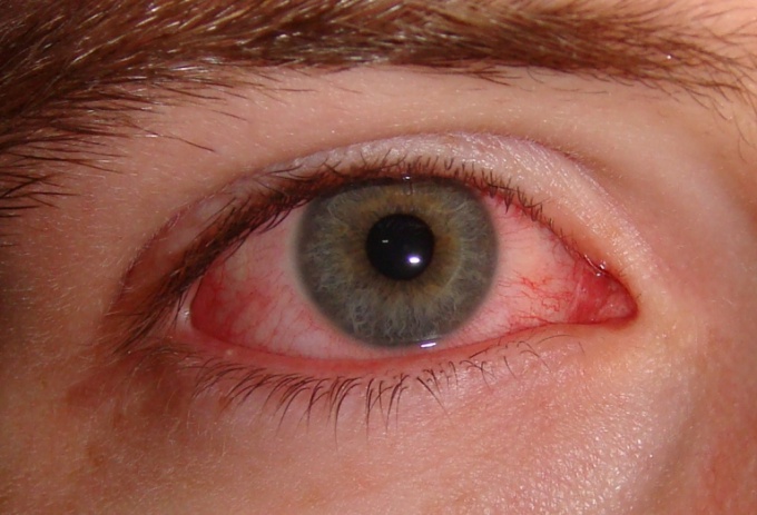 How to get rid of red blood vessels in the eyes