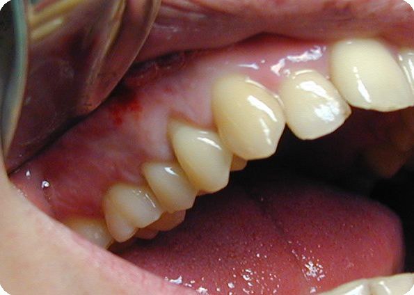 What to do when swollen gums