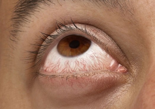 Why burst capillaries in the eyes