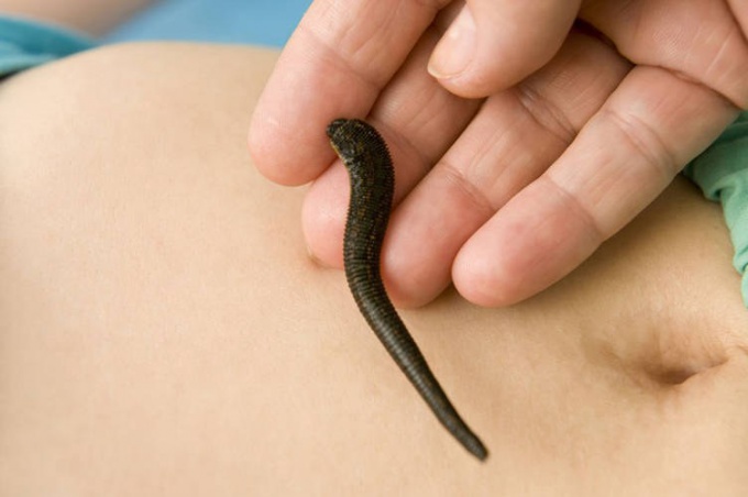 How to stop the bleeding after leeches