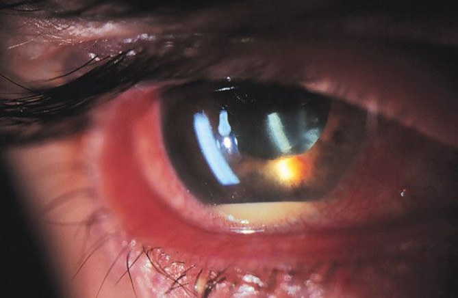 Почему белок глаза красный