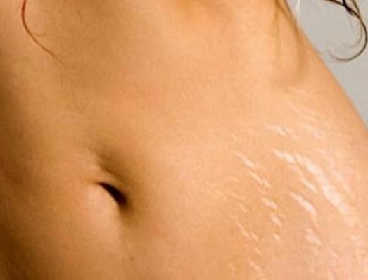 How to get rid of white stretch marks