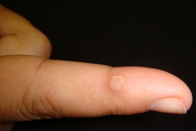 How to cure a wart