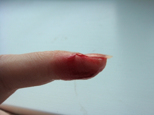 Как остановить кровь из пальца