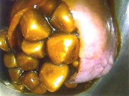 How to pull stones in the gallbladder