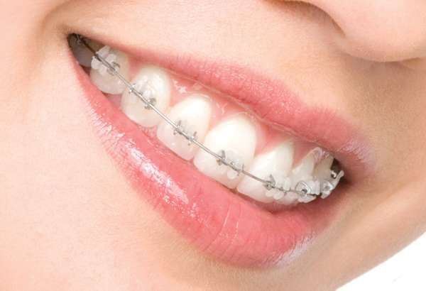 How to remove the gap between the <b>front</b> <em>teeth</em>