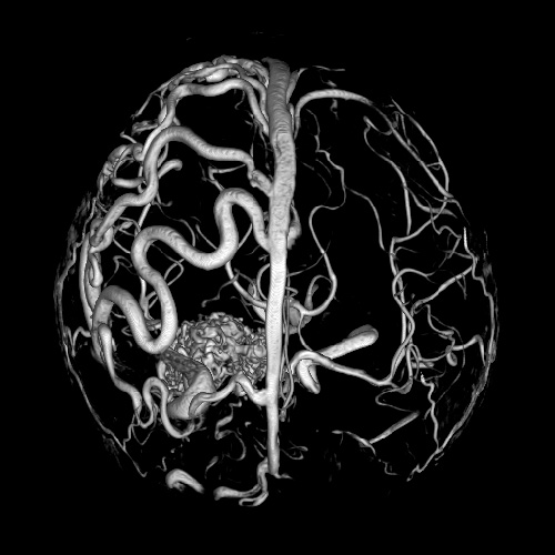 How to expand blood vessels of the brain