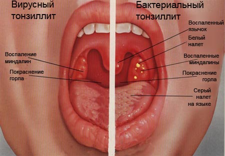 Как лечить першение в горле