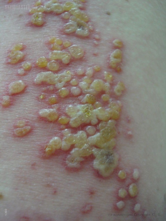 Shingles.