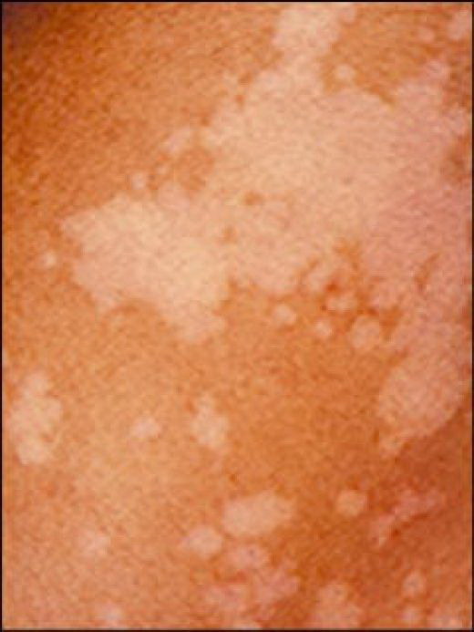 Pityriasis versicolor.