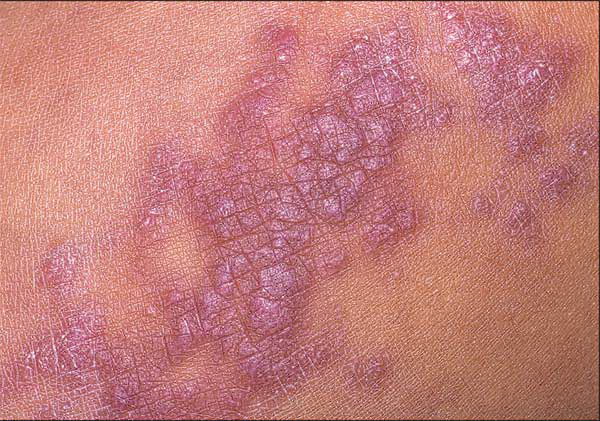 Lichen planus.