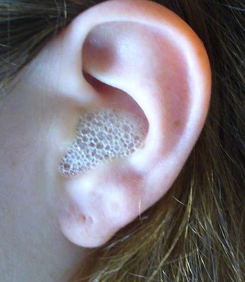 How to treat fungus in the ear