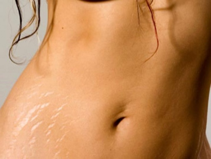 How to get rid of old stretch marks