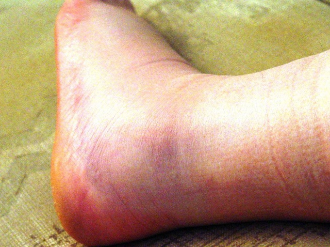 How to treat an ankle fracture