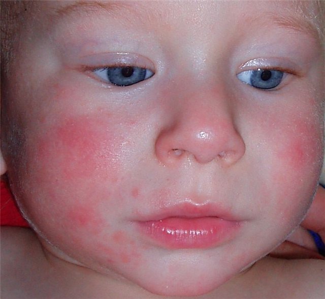 How to cure atopic dermatitis in child