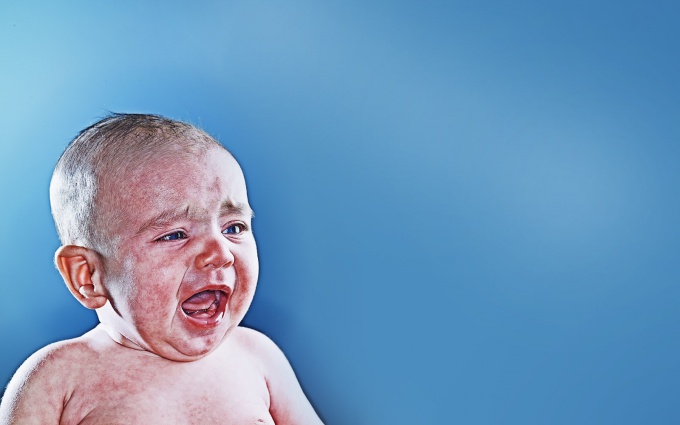 Как лечить аллергию у ребенка до года