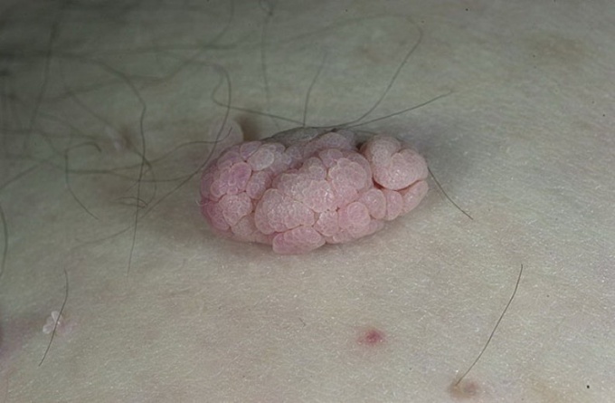How to withdraw papilloma in the home
