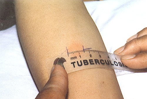 How to identify tuberculosis