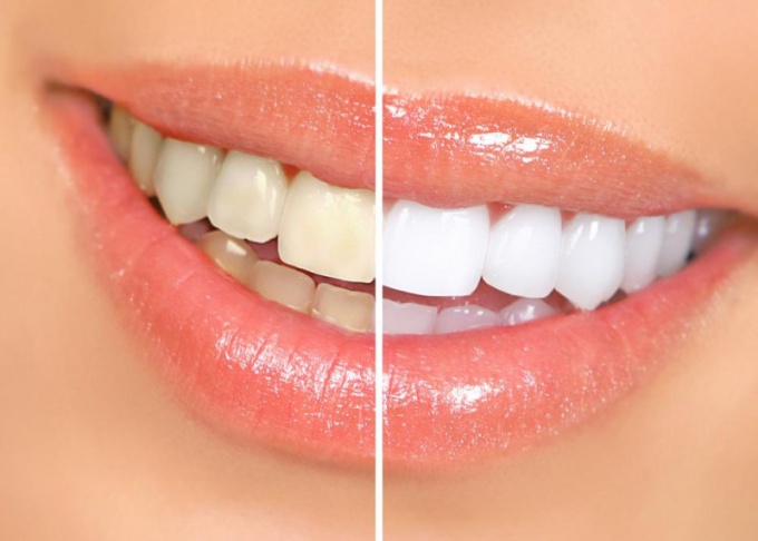 How to whiten teeth in a week