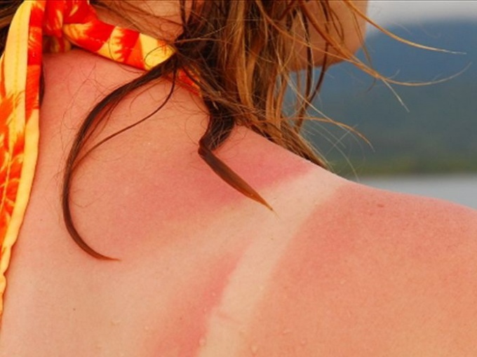How to remove redness after sun