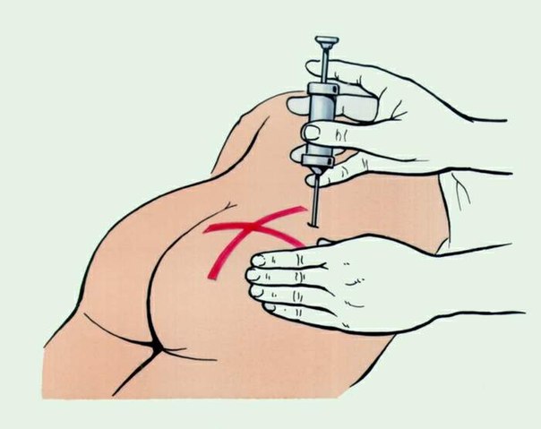 Give the injection in the outer upper quadrant