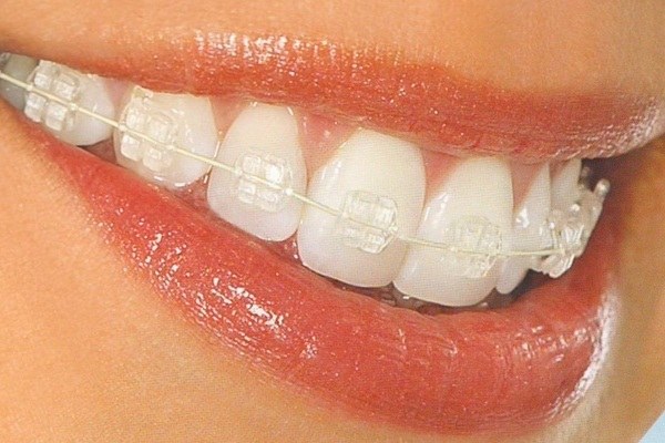 When to put braces