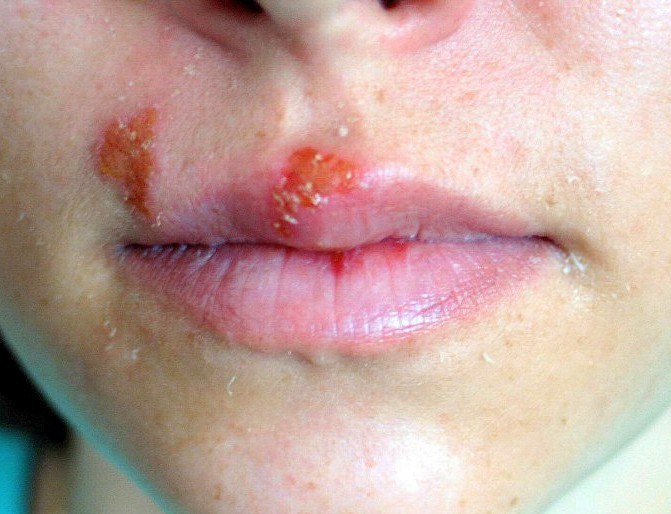 Often herpes – reduction of immunity, so in addition to the treatment of a viral infection should strengthen the body's defenses