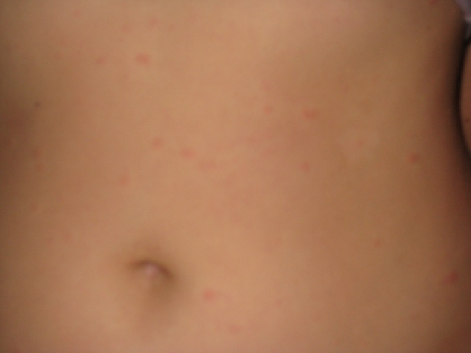  Itchy abdomen - what to do? Why the stomach small rash? 