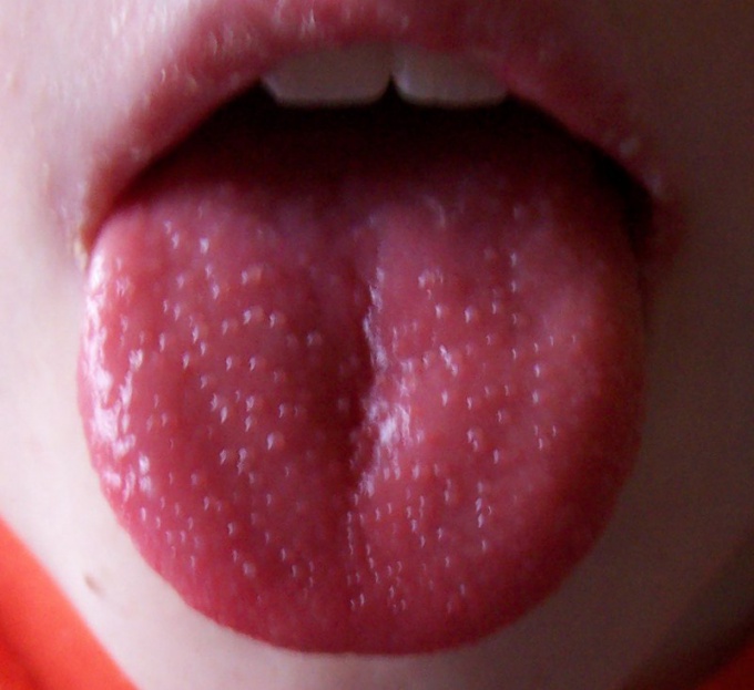 Here so can look like red dots on the tongue