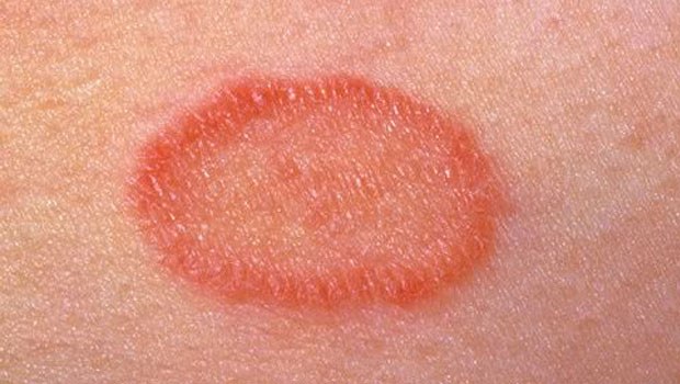 How to treat skin herpes