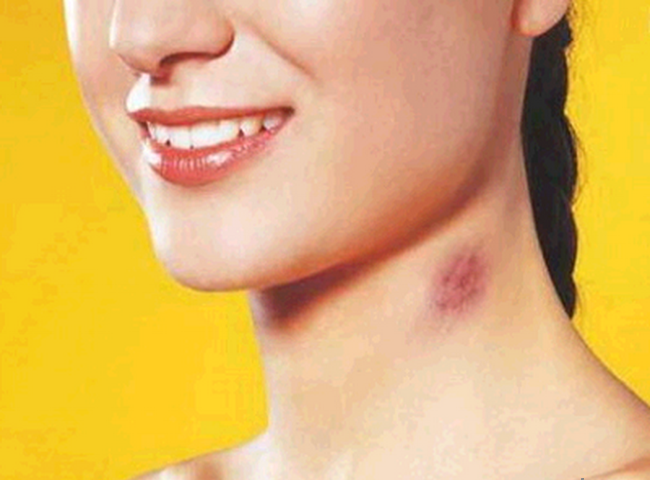 Home remedies for hickeys and bruises