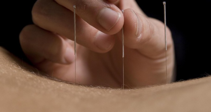 Acupuncture: benefit or harm