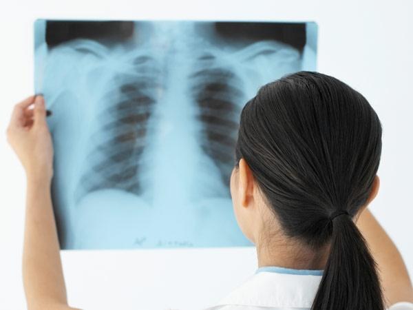 Chest x-rays should take place once a year