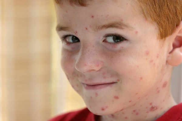 How is the chickenpox in teenagers