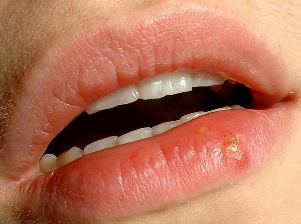 ulcer on the lip