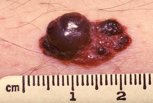 Malignant nevus