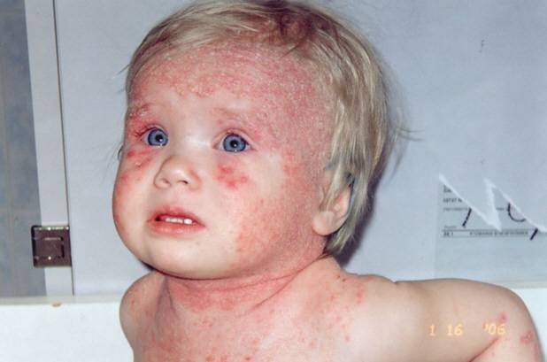 Как выглядит дерматит у ребенка