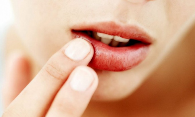 How to get rid of herpes forever