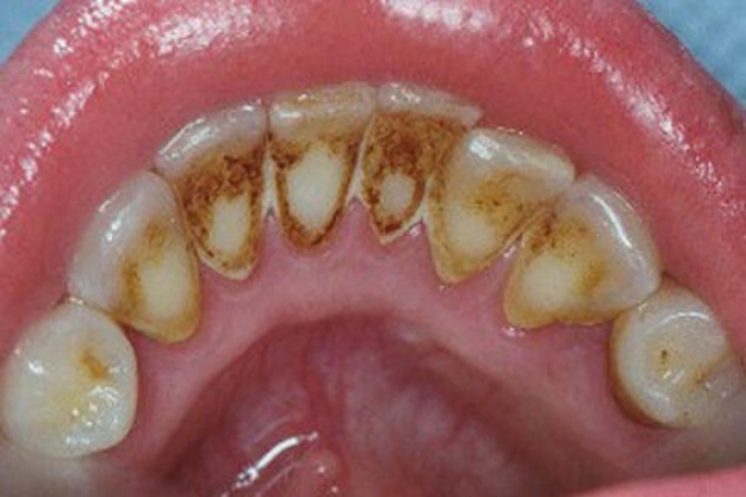 Зубной камень, как его лечить, профилактика