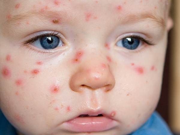 Why adults suffer heavier chickenpox than children
