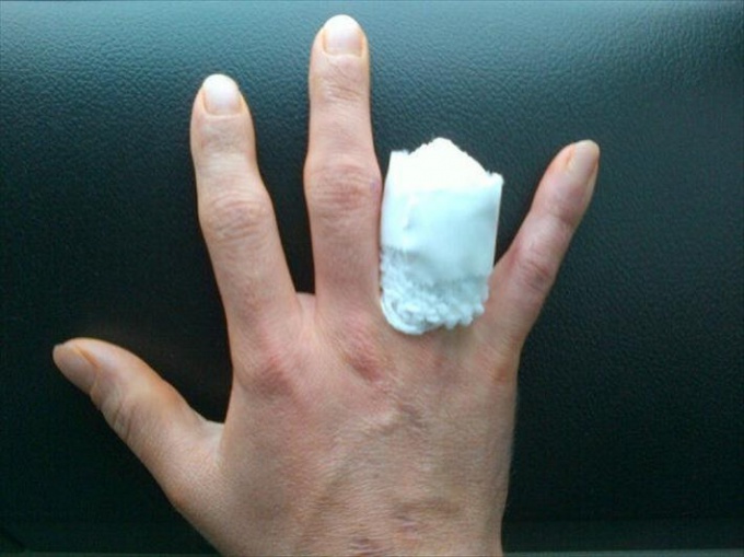 Compressive bandage on the stump in amputation of the finger.