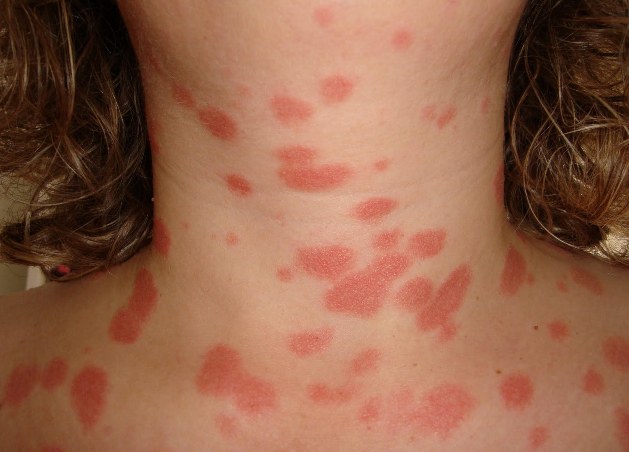 What is psoriasis and how to treat it