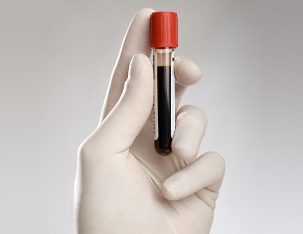 How to pass a blood test for cortisol 