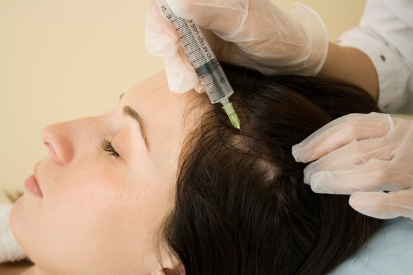 Эффективна ли мезотерапия при выпадении волос 