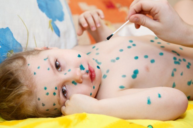 Complications of chickenpox in children 